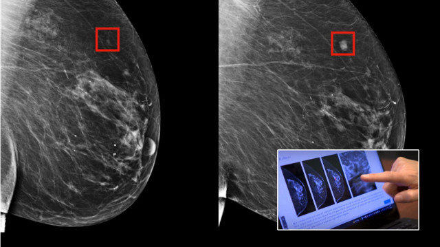 Yapay zeka kanser riskini tahmin edebiliyor