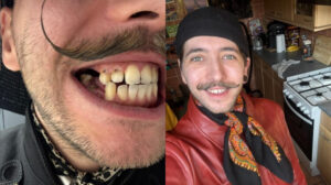 Diş korkusu bütün dişlerinin dökülmesine neden oldu