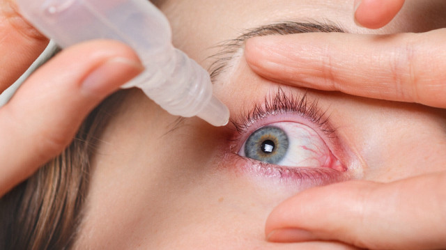 Göz kapaklarında kızarıklık ve şişlik blefarit belirtisi olabilir