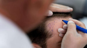 Saç ekimi sonrası dikkat edilmesi gerekenler: Yeni saçlarınızı korumak için 10 ipucu