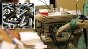 Nadir görülen bir olay: 60 yaşındaki hastanın midesinden 47 cıvata çıkarıldı