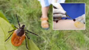 Sivas’ta KKKA hastalığı tanısı konulan 6 kişinin tedavisi sürüyor