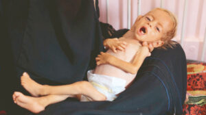 66 çocuk açlıktan öldü