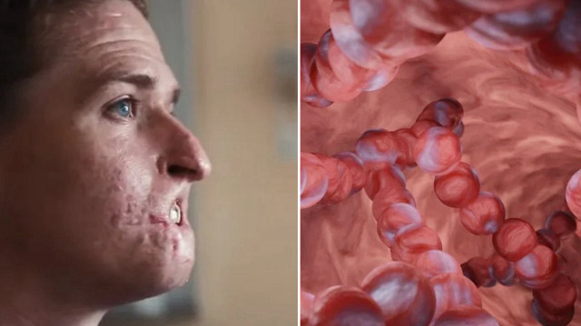 Ilık ve tuzlu sularda yaşayan “et yiyen bakteri” yüzünden 4 kişi hayatını kaybetti