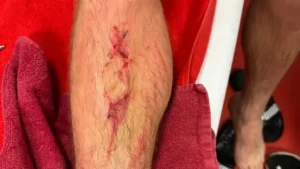 Galatasaraylı futbolcunun görüntüsü şoke etti: Bacağı kırılabilirdi