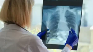 İleri evre akciğer kanserinde ‘yenilikçi tedavi’ dönemi