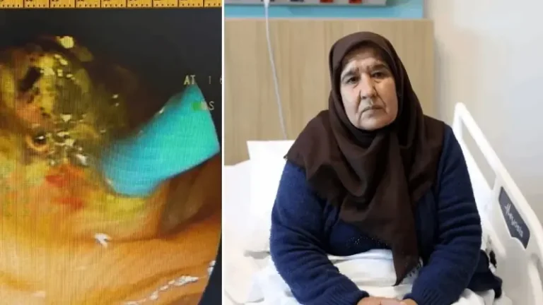 ‘Kalbim sağda atıyor’ dedi, kimseyi inandıramadı: Mide ağrısı için hastaneye başvurdu, gerçek 66 yıl sonra anlaşıldı