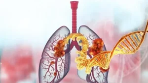 Türk bilim insanları akciğer kanserinde radyoterapiye yanıtı belirleyen 12 gen tespit etti