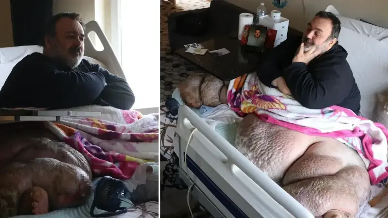 Beş yıldır evden çıkamıyor 300 kiloya ulaştı: Hastalığı yatağa bağımlı hale getirdi! 12 yıl sonra umut ışığı
