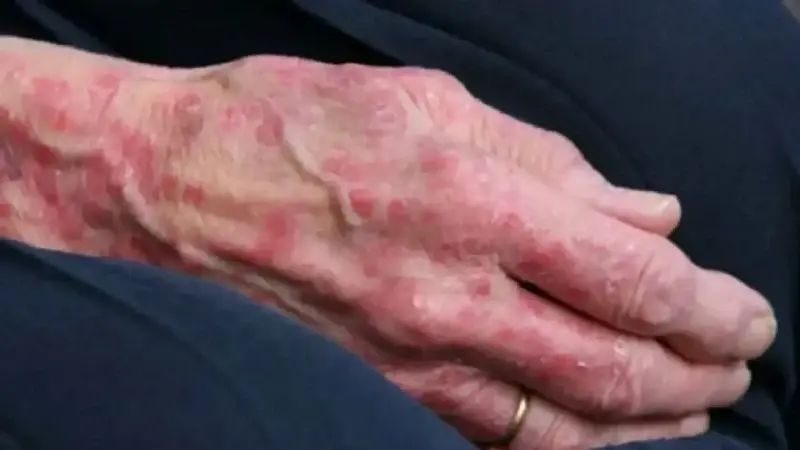 Romanya ve Hırvatistan’da cüzzam vakaları görüldü: 40 yıl sonra ilk