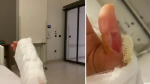 Sıcak su torbası patladı genç kızın vücudunun yüzde 25’i yandı: ‘O acının tarifi yok’