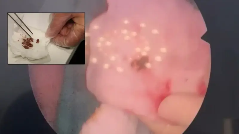 Yıllarca fark etmedi estetik ameliyatta ortaya çıktı: Burunda rinolit şoku