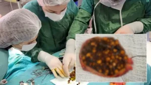 Karın ağrısıyla gitti içinden tam binlerce çıktı! Manisa’daki ameliyatta görülen manzara doktorları bile hayrete düşürdü