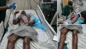 Nadir bir cilt hastalığı bulunan Filistinli genç yaşam mücadelesi veriyor