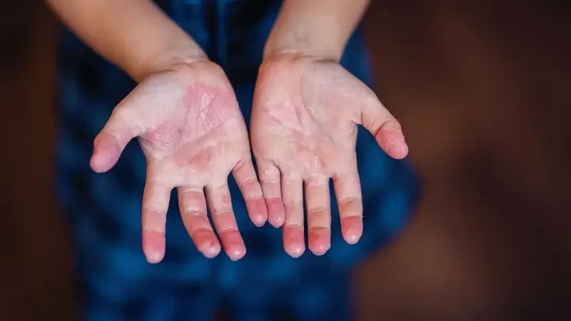 ‘Fabry’ hastalığında erken tanı için aile taraması önem taşıyor