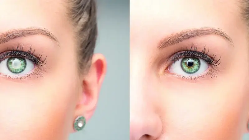 Genç gözlerde katarakt artıyor