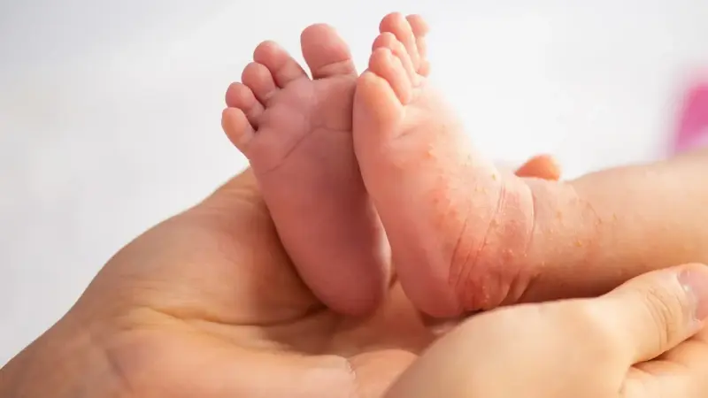 Yapay zeka destekli mobil uygulamayla bebeklerde cilt sorunlarının erken teşhis edilmesi hedefleniyor