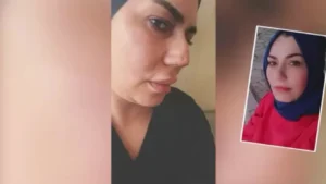 Estetik ameliyatında burnu bu hale geldi doktordan şikayetçi oldu