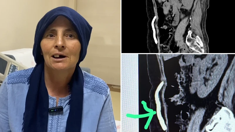 Kafatası kemiği sekiz ay karnında saklandı: Nakille sağlığına kavuştu