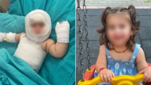 Misafirlikte patlayan mutfak eşyası Eliz’in yüzünü ve vücudunu yaktı